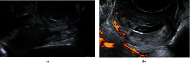 Treatment of Cervical Pregnancy with Ultrasound-Guided Intragestational Injection of Methotrexate: A Case Report.