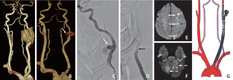 Cascade of Complications Following Carotid Body Tumor Excision.