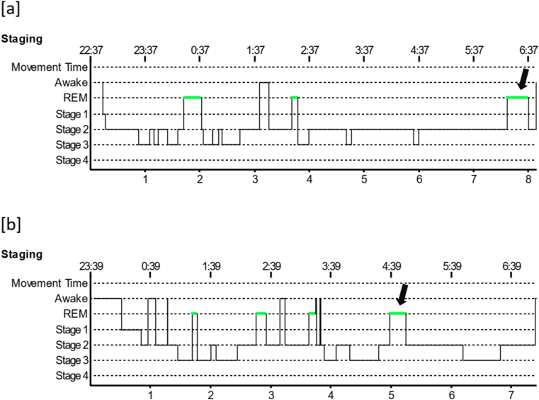 Rapid eye movement (REM) sleep microarchitecture is altered in patients with wake-up ischemic stroke: A polysomnographic study