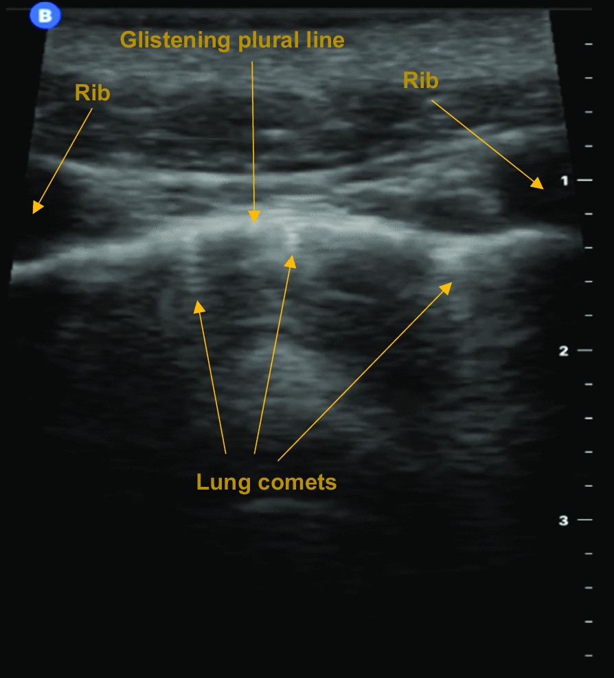 Helicopter emergency medical services use of thoracic point of care ultrasound for pneumothorax: a systematic review and meta-analysis.
