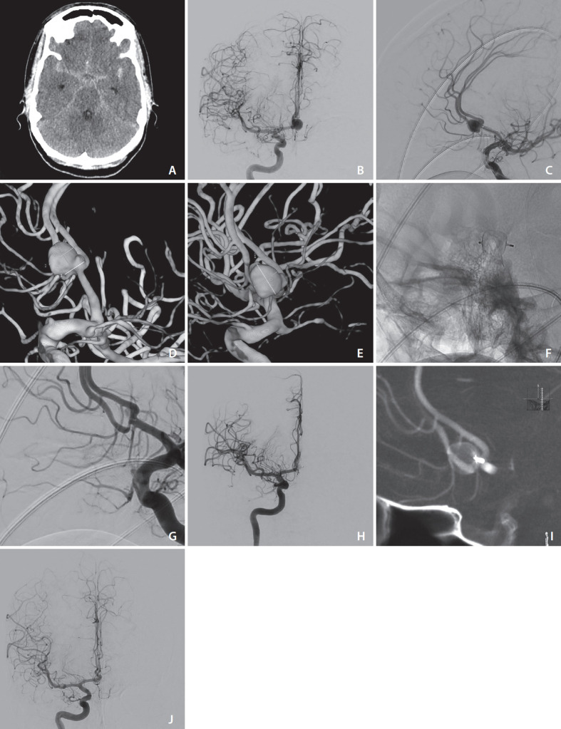 Ten Years of Clinical Evaluation of the Woven EndoBridge: A Safe and Effective Treatment for Wide-Neck Bifurcation Aneurysms.