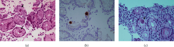 CMV-Related Gastric Ulcer and Gastroduodenitis in an Immunocompetent Patient: A Case Report and Literature Review.