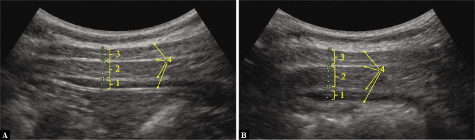 Intra-examiner and inter-examiner reliability of rehabilitative ultrasound imaging for lumbar multifidus and anterolateral abdominal muscles in females with recurrent low back pain: an observational, cross-sectional study.