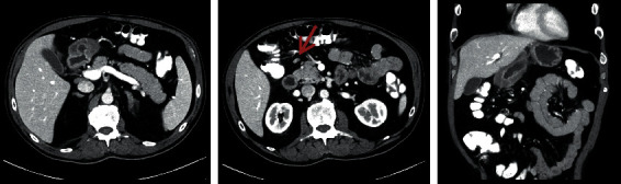 CMV-Related Gastric Ulcer and Gastroduodenitis in an Immunocompetent Patient: A Case Report and Literature Review.