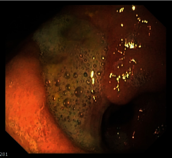 CMV-Related Gastric Ulcer and Gastroduodenitis in an Immunocompetent Patient: A Case Report and Literature Review.