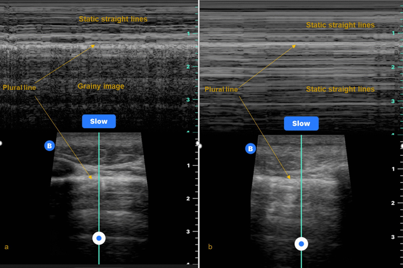 Helicopter emergency medical services use of thoracic point of care ultrasound for pneumothorax: a systematic review and meta-analysis.