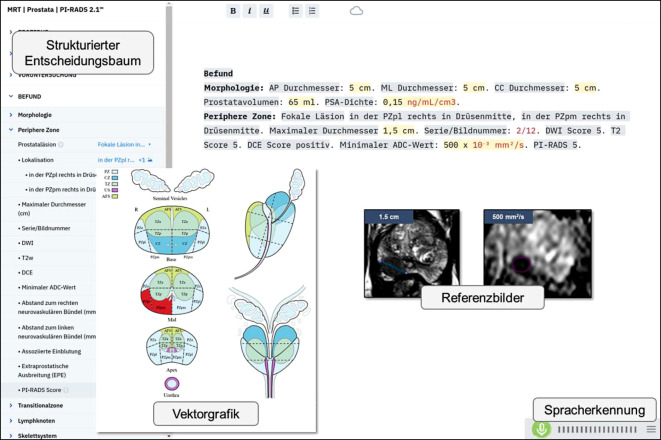 [Integration of structured reporting into the routine radiological workflow].