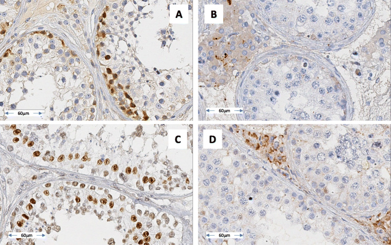 Azoospermia and reciprocal translocations: should whole-exome sequencing be recommended?