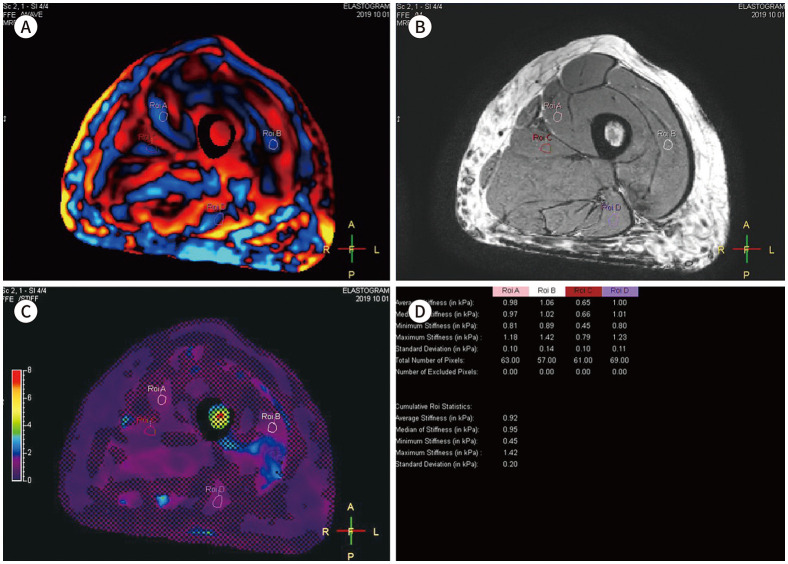 Quantification of the Elastic Property of Normal Thigh Muscles Using MR Elastography: Our Initial Experience.
