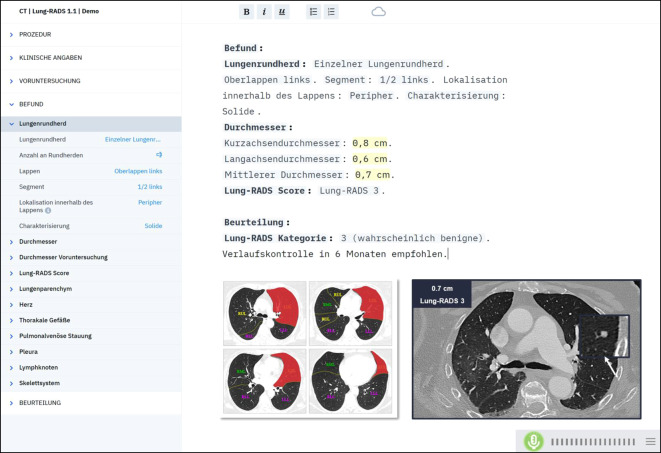 [Integration of structured reporting into the routine radiological workflow].