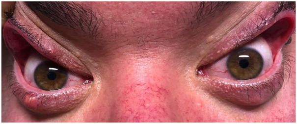 Floppy eyelid, an under-diagnosed syndrome: a review of demographics, pathogenesis, and treatment.