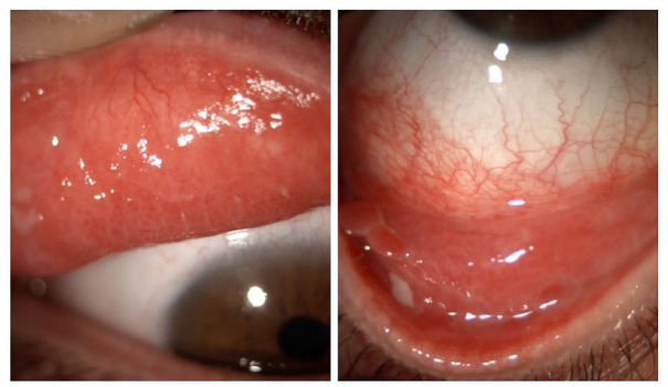 Floppy eyelid, an under-diagnosed syndrome: a review of demographics, pathogenesis, and treatment.