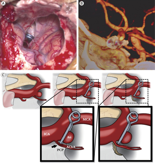 Flow recovery after posterior clinoidectomy for surgical clipping of anterior choroidal aneurysm.