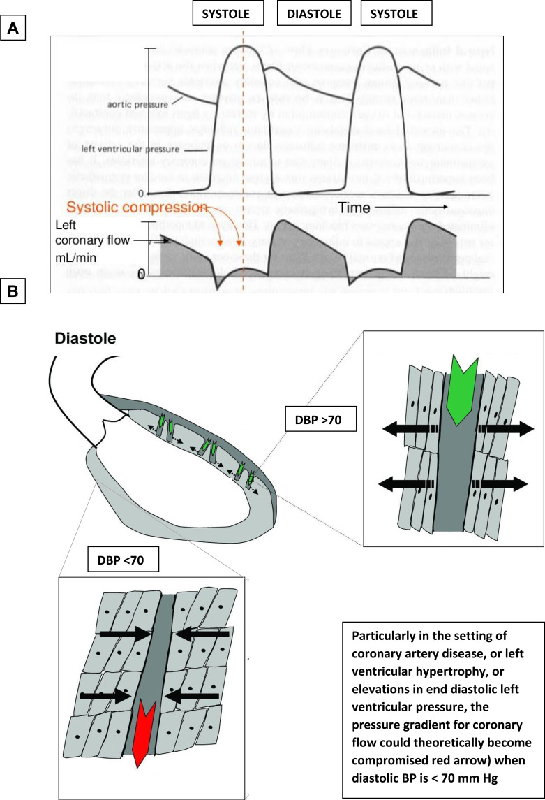 The Diastolic Blood Pressure J-Curve in Hypertension Management: Links and Risk for Cardiovascular Disease.