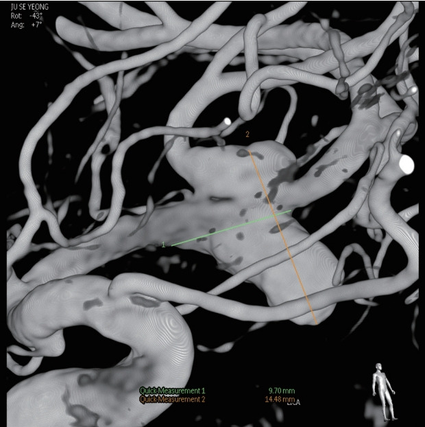 Staged hybrid treatment for giant thrombosed fusiform aneurysm.