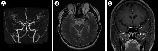 Staged hybrid treatment for giant thrombosed fusiform aneurysm.