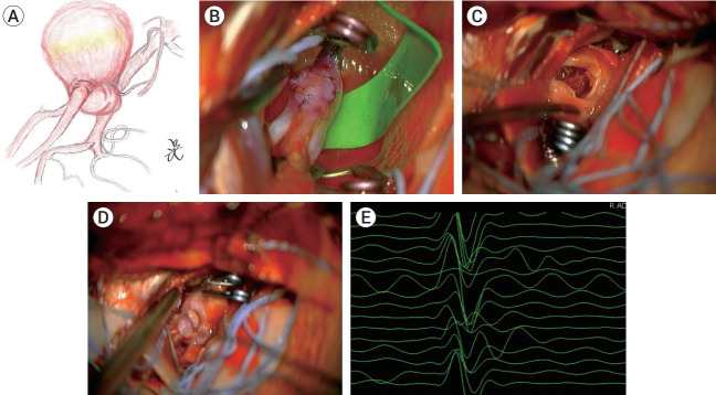 Staged hybrid treatment for giant thrombosed fusiform aneurysm.