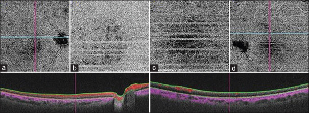 Laser-Induced Maculopathy Masquerading as Hereditary Macular Dystrophy.