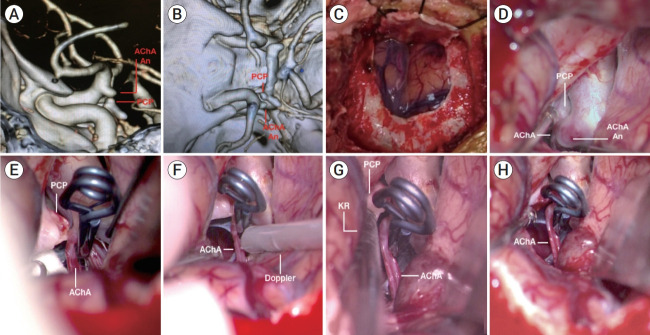 Flow recovery after posterior clinoidectomy for surgical clipping of anterior choroidal aneurysm.