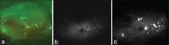 Manifestation of Panuveitis after Intraocular Surgery in a Child with Blau Syndrome.