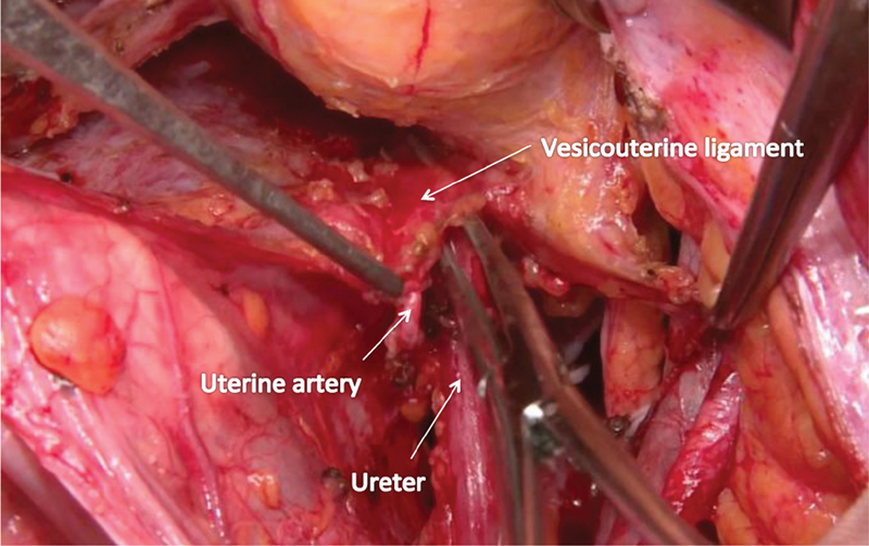Nerve-Sparing Radical Hysterectomy Using the Okabayashi-Kobayashi Method.