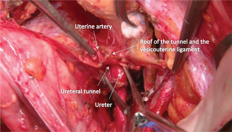 Nerve-Sparing Radical Hysterectomy Using the Okabayashi-Kobayashi Method.