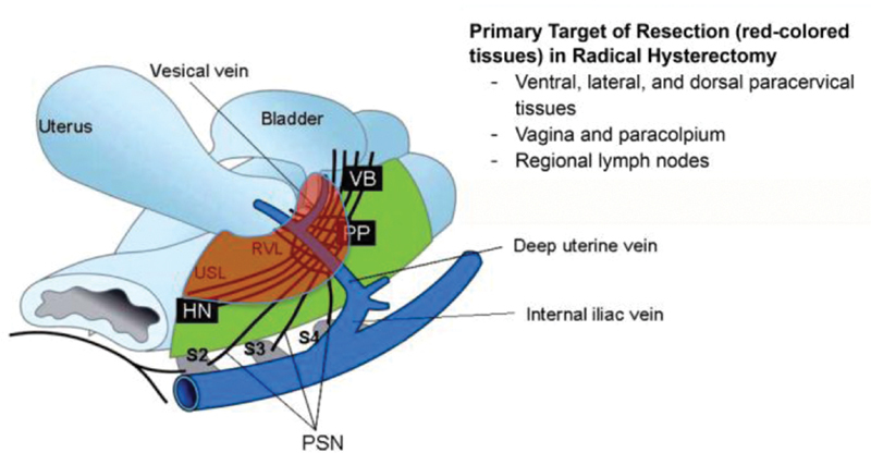 Nerve-Sparing Radical Hysterectomy Using the Okabayashi-Kobayashi Method.