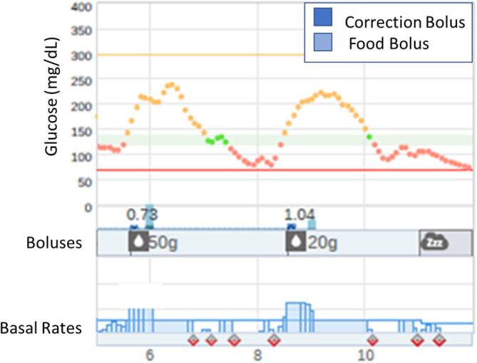 Practical aspects of diabetes technology use: Continuous glucose monitors, insulin pumps, and automated insulin delivery systems