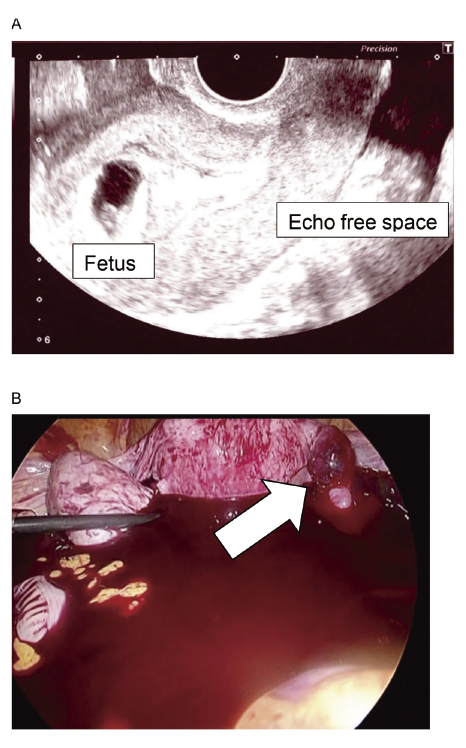 First trimester heterotopic pregnancy with shock treated laparoscopically, followed by uneventful term pregnancy and normal birth.