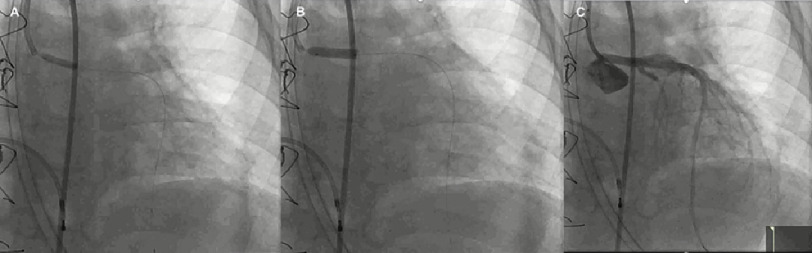 Coronary allograft vasculopathy managed by Flash ostial balloon in a pediatric patient.