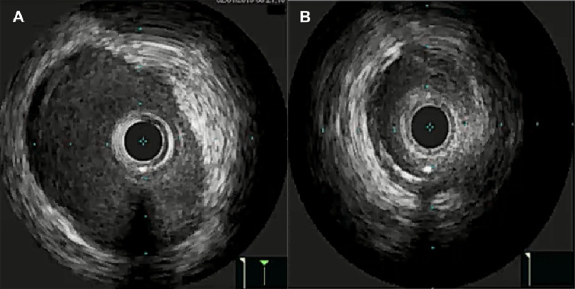 Coronary allograft vasculopathy managed by Flash ostial balloon in a pediatric patient.