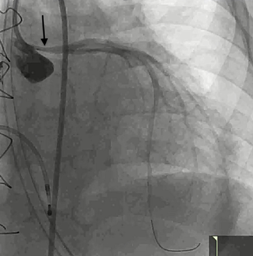 Coronary allograft vasculopathy managed by Flash ostial balloon in a pediatric patient.