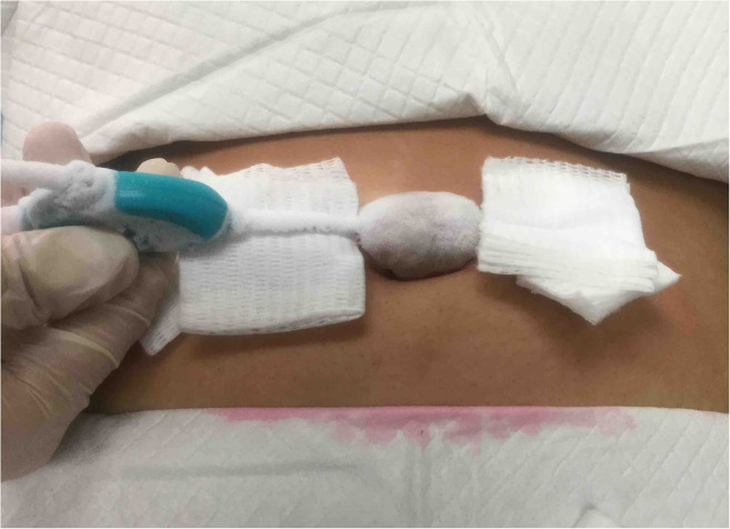 Intralesional cryotherapy with triamcinolone and onabotulinumtoxinA injections for umbilical keloid: A case report.