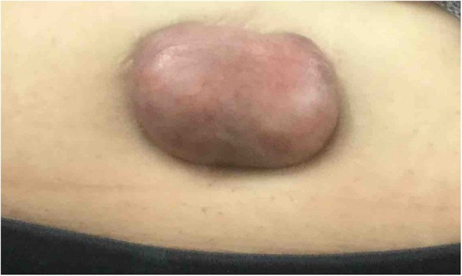 Intralesional cryotherapy with triamcinolone and onabotulinumtoxinA injections for umbilical keloid: A case report.