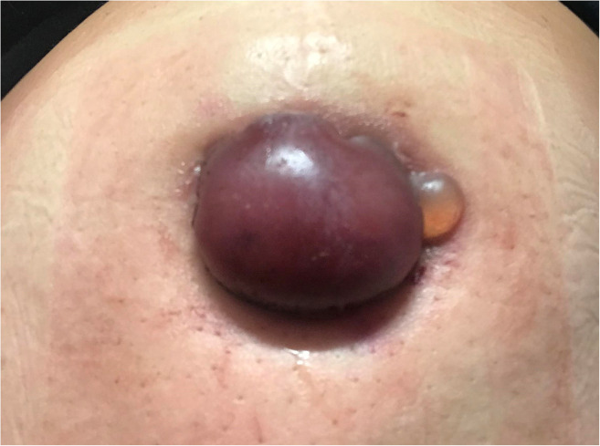 Intralesional cryotherapy with triamcinolone and onabotulinumtoxinA injections for umbilical keloid: A case report.