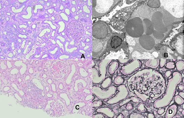 A Case of Acute Interstitial Nephritis After Two Doses of the BNT162b2 SARS-CoV-2 Vaccine.