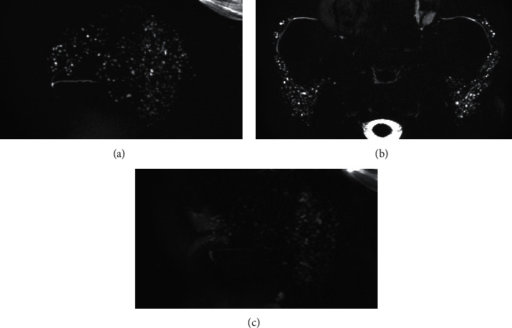 Comparative Study of Multiple High-Signal-Intensity Spots on 3D and 2D Magnetic Resonance Sialography for Patients with Sjögren's Syndrome.