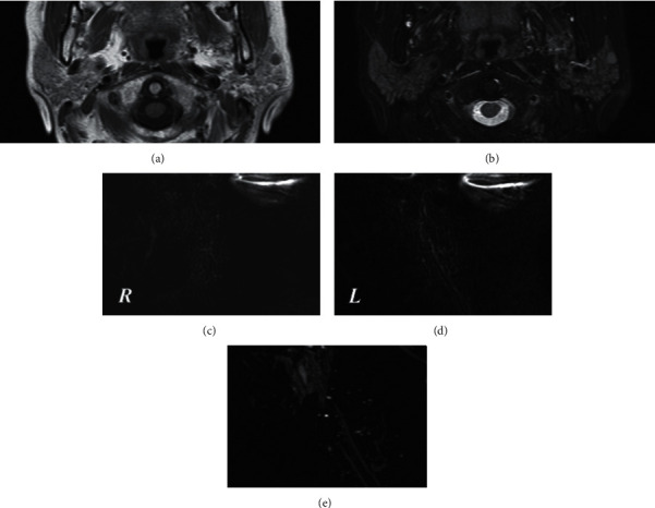 Comparative Study of Multiple High-Signal-Intensity Spots on 3D and 2D Magnetic Resonance Sialography for Patients with Sjögren's Syndrome.