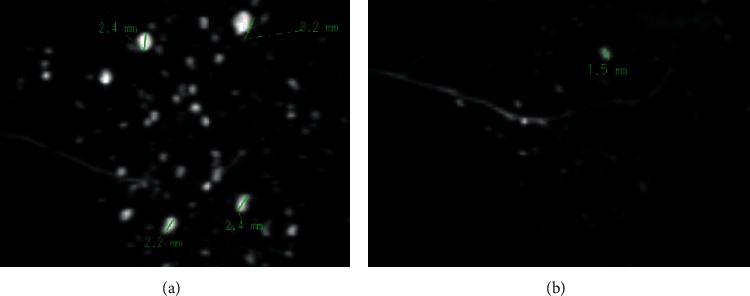 Comparative Study of Multiple High-Signal-Intensity Spots on 3D and 2D Magnetic Resonance Sialography for Patients with Sjögren's Syndrome.