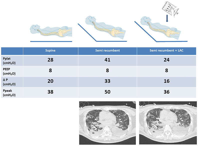 Continuous Lower Abdominal Compression as a Therapeutic Intervention in COVID-19 ARDS.