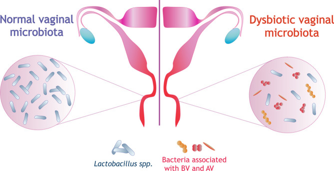 Can <i>Lactobacillus</i> spp. Be a Factor Reducing the Risk of Miscarriage?