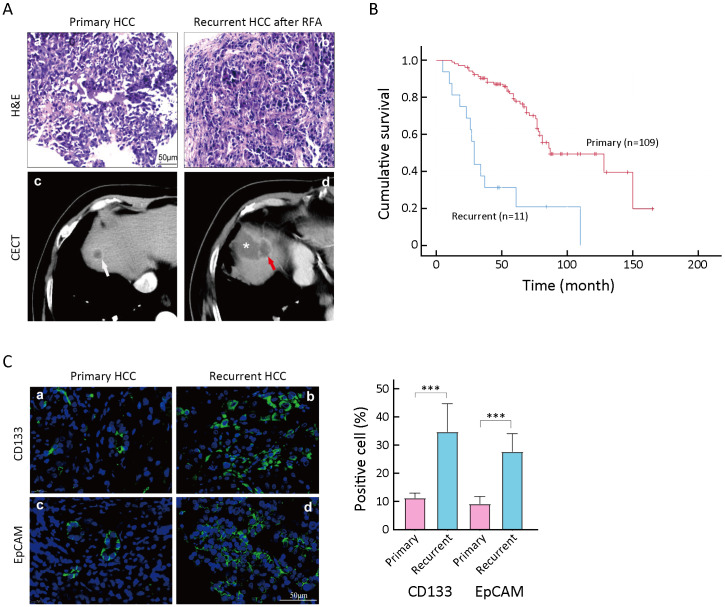 All-trans retinoic acid (ATRA) inhibits insufficient radiofrequency ablation (IRFA)-induced enrichment of tumor-initiating cells in hepatocellular carcinoma.