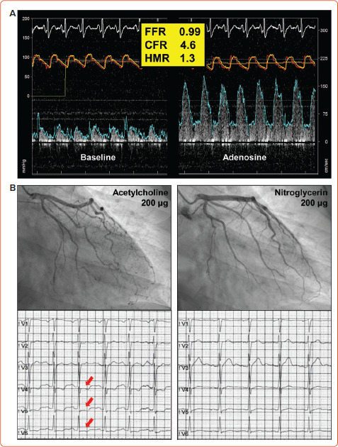 Definitions and Epidemiology of Coronary Functional Abnormalities.