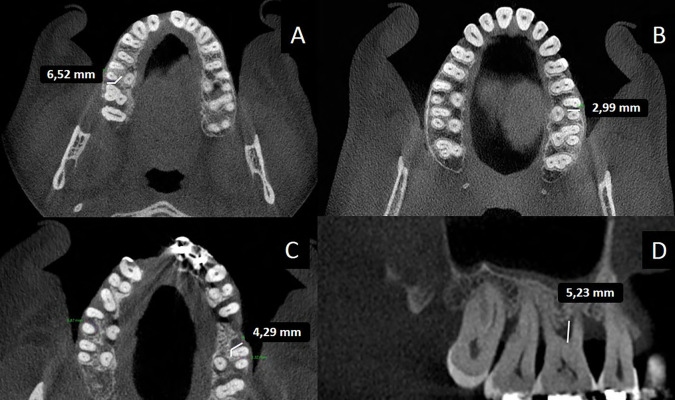 Comparison of cone-beam computed tomography, clinical and surgical analysis for detection of maxillary molar furcation.