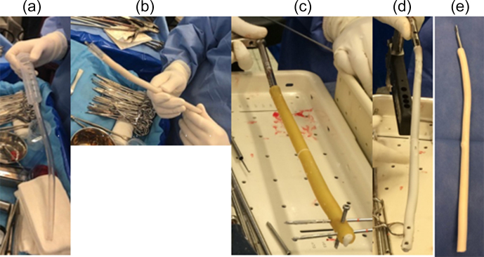 The effectiveness of antibiotic cement-coated nails in post-traumatic femoral and tibial osteomyelitis - comparative analysis of custom-made versus commercially available nails.