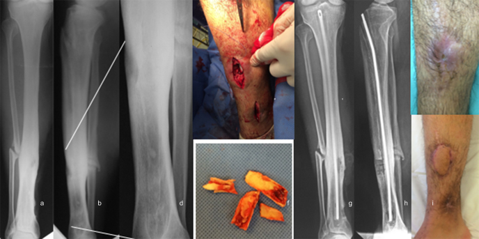 The effectiveness of antibiotic cement-coated nails in post-traumatic femoral and tibial osteomyelitis - comparative analysis of custom-made versus commercially available nails.