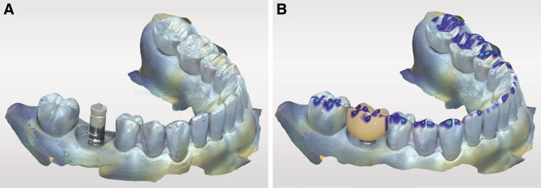 Efficiency of occlusal and interproximal adjustments in CAD-CAM manufactured single implant crowns - cast-free vs 3D printed cast-based.