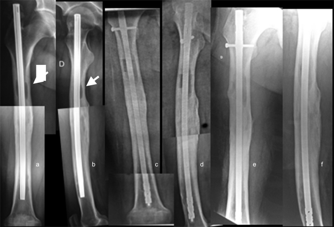 The effectiveness of antibiotic cement-coated nails in post-traumatic femoral and tibial osteomyelitis - comparative analysis of custom-made versus commercially available nails.