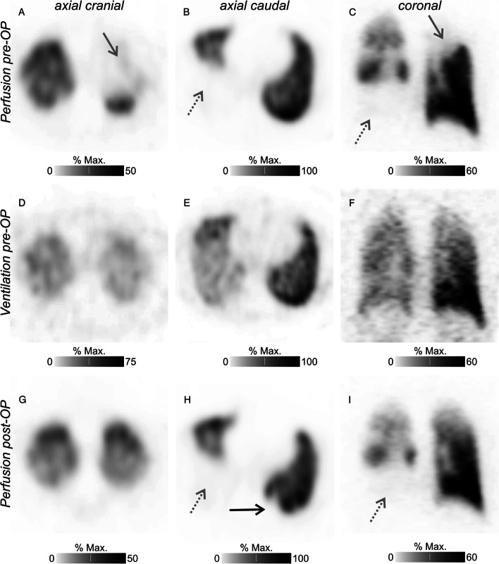 Atypical bilateral ventilation/perfusion mismatches in an asymptomatic patient suffering from metastatic thyroid cancer.