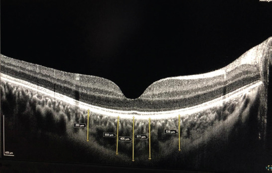 How are central foveal and choroidal thickness affected in patients with mild COVID-19 infection?